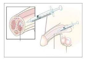 Penis Enjeksiyonları