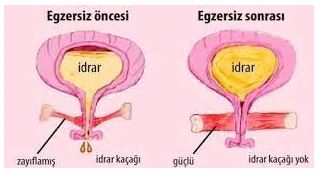 İdrar Kaçırma