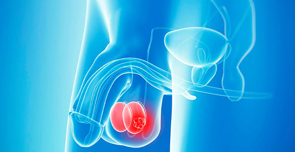 Testis Kanseri