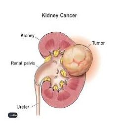 Kidney Cancer