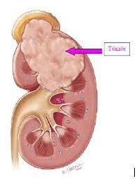 Kidney Cancer
