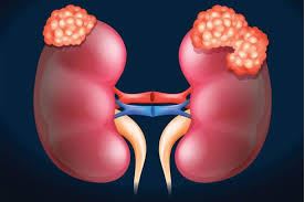 Kidney Cancer