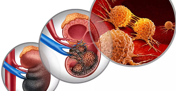 Kidney Cancer