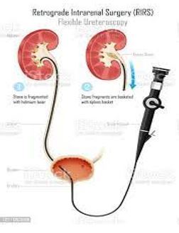 Kidney and Ureter Stones