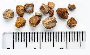 Kidney and Ureter Stones