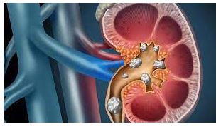 Kidney and Ureter Stones