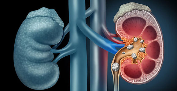 Kidney and Ureter Stones
