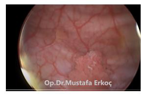 Bladder Cancer