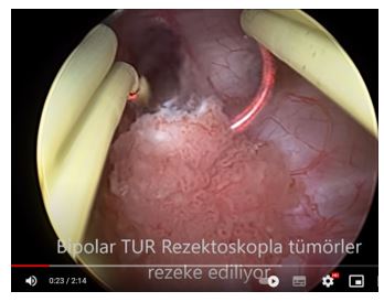 Bladder Cancer Bladder Cancer