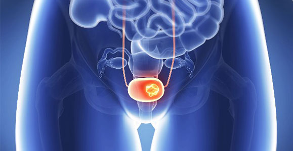 Bladder Cancer
