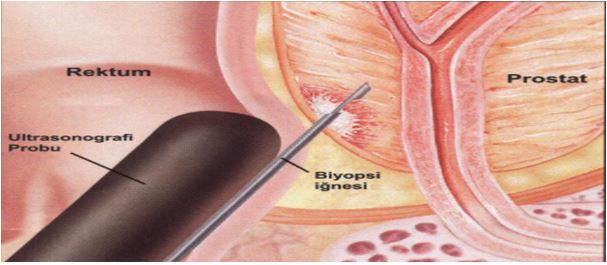 Prostate Cancer
